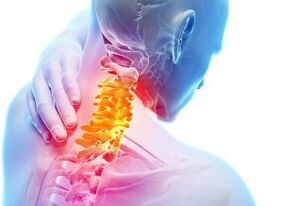 Dolore e fitta nella zona cervicale con osteocondrosi di terzo grado